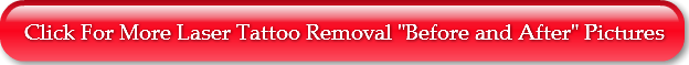 click-for-more-laser-tattoo-removal-bef