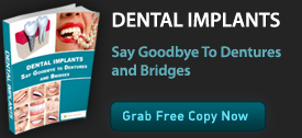 dental-implants-1