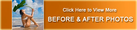 before-and-after-smartlipo-vaser-liposuction-sil